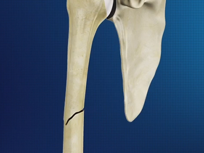 Humerus Fracture Care - Educational Picture